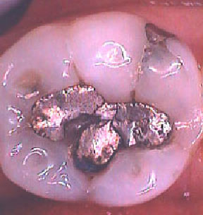 Fillings Gallery Case 5 Porcelain Onlay 