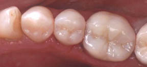 Fillings Gallery Case 6 - A Porcelain Inlay and Onlay 