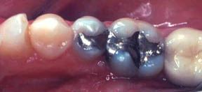 Fillings Gallery Case 6 - A Porcelain Inlay and Onlay 
