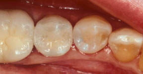 Fillings Gallery Case 7 Porcelain Inlay 