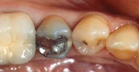 Fillings Gallery Case 7 Porcelain Inlay 
