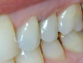Fillings Gallery Case 9 Composite Inlay 