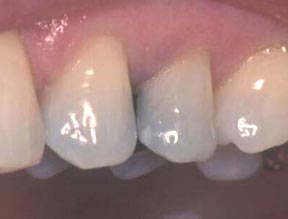 Fillings Gallery Case 9 Composite Inlay 