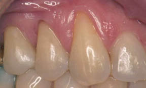 Fillings Gallery Case 10 Composite Bonding 