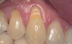 Fillings Gallery Case 10 Composite Bonding 