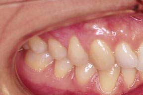 Periodontal Gallery - Soft Tissue Graft Case 1 