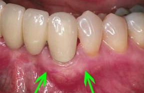 Periodontal Gallery - Soft Tissue Graft Case 2 