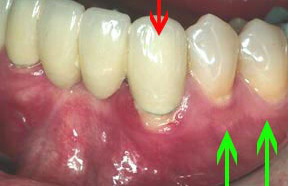 Periodontal Gallery - Soft Tissue Graft Case 2 
