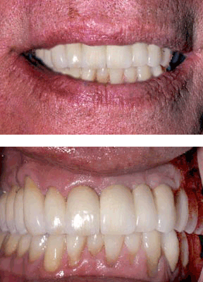 Implants Gallery Case 3 