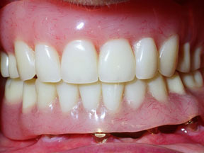 Implants Gallery Case 4 