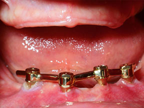 Implants Gallery Case 4 