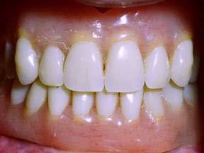 Implants Gallery Case 5 