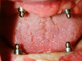 Implants Gallery Case 5 
