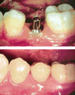 Implants Gallery Case 6 