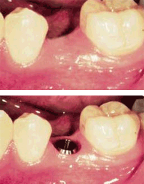 Implants Gallery Case 6 