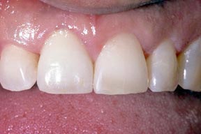 Implants Gallery Case 1 
