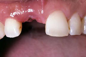 Implants Gallery Case 1 