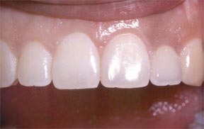 Implants Gallery Case 2 