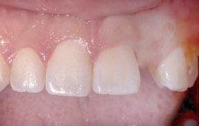 Implants Gallery Case 2 