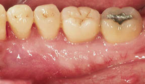 Periodontal Gallery - Tori Removal 