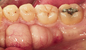 Periodontal Gallery - Tori Removal 