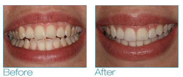 Mindy before and after #2
