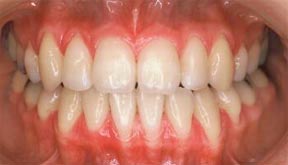 Orthodontic Gallery Case 2 