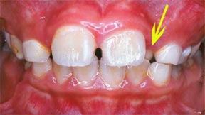 Orthodontic Gallery Case 4 