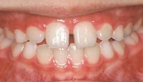 Orthodontic Gallery Case 5 