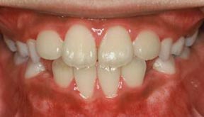 Orthodontic Gallery Case 6 