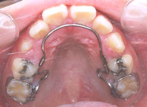 Orthodontic Gallery Case 9 