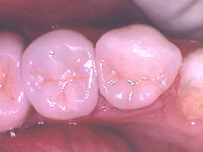 Fillings Case 1 