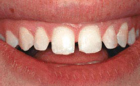 Porcelain Veneers Gallery Case 2 