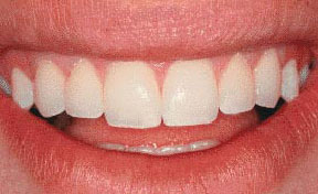 Porcelain Veneers Gallery Case 2 