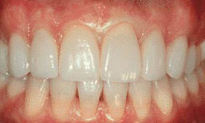 Porcelain Veneers Gallery Case 1 