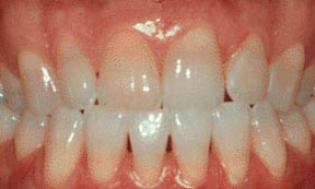 Porcelain Veneers Gallery Case 1 