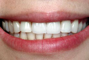 Porcelain Veneers Gallery Case 3 
