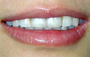 Porcelain Veneers Gallery Case 3 