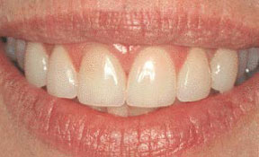 Porcelain Veneers Gallery Case 4 