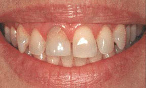 Porcelain Veneers Gallery Case 4 