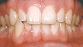 Porcelain Veneers Gallery Case 5 