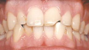 Porcelain Veneers Gallery Case 5 