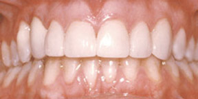 Porcelain Veneers Gallery Case 6 