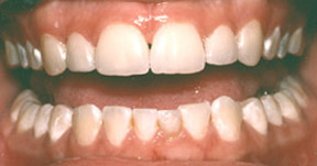Porcelain Veneers Gallery Case 8 