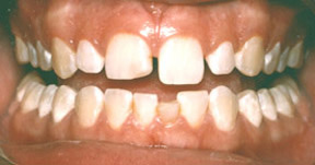 Porcelain Veneers Gallery Case 8 