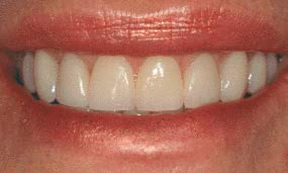 Porcelain Veneers Gallery Case 9 