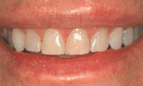 Porcelain Veneers Gallery Case 9 