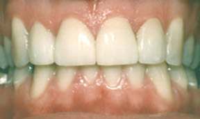 Porcelain Veneers Gallery Case 10 