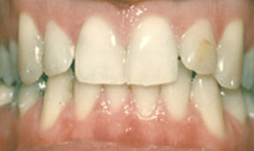 Porcelain Veneers Gallery Case 10 
