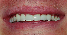 Porcelain Veneers Gallery Case 11 
